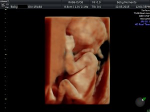 16 wks Pregnancy scan 